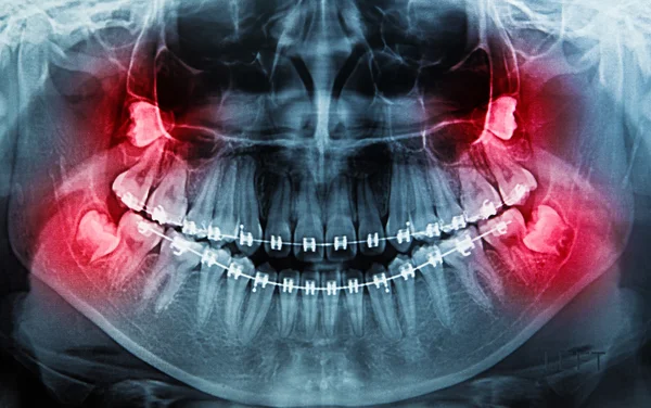 Рентгеновское сканирование человека на зубы — стоковое фото