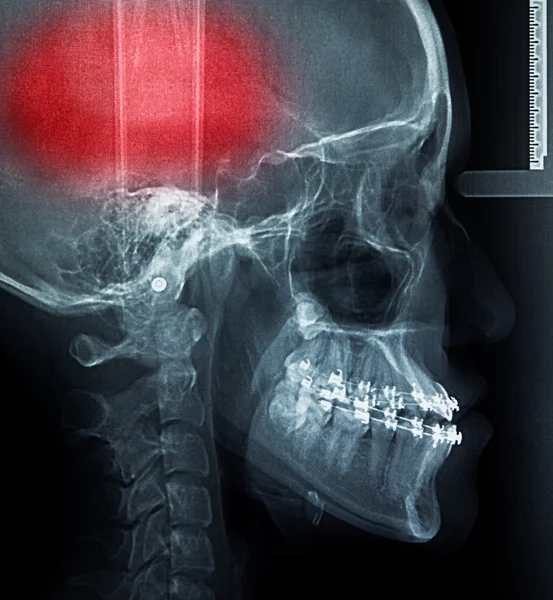 X-ray skanowania człowieka — Zdjęcie stockowe