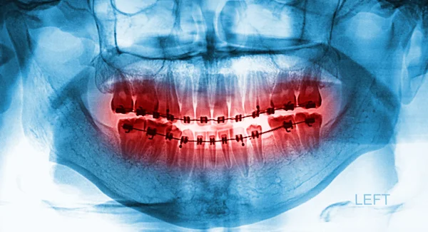 人类牙齿的 x 线扫描 — 图库照片