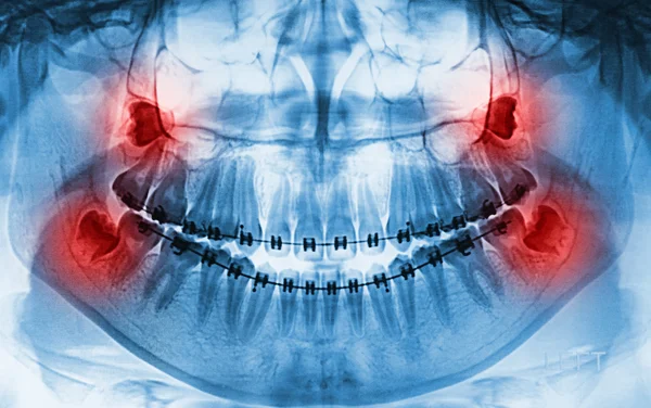 Rayos X escanear humanos para los dientes — Foto de Stock