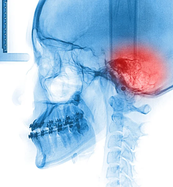 Röntgenbild Mensch — Stockfoto