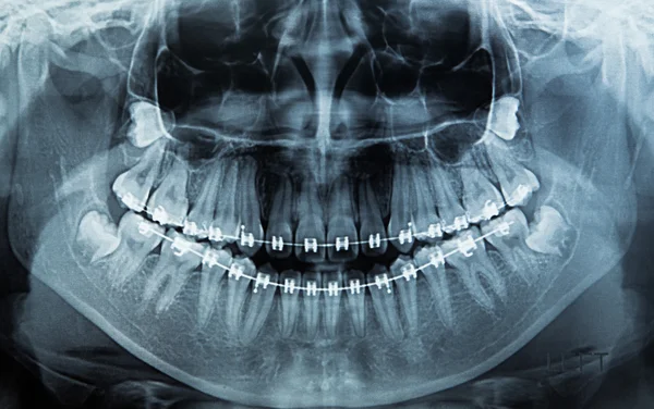 X-ray skanowania człowieka — Zdjęcie stockowe