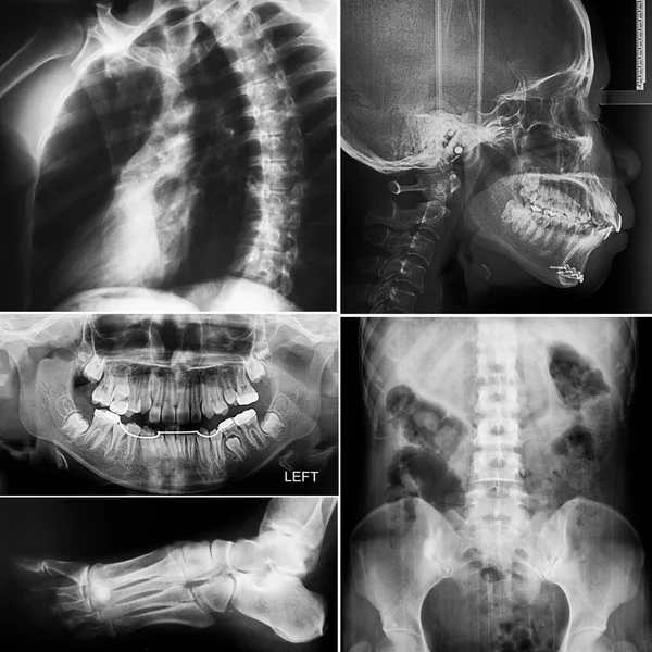 Collage of human X-rays photo — Stock Photo, Image