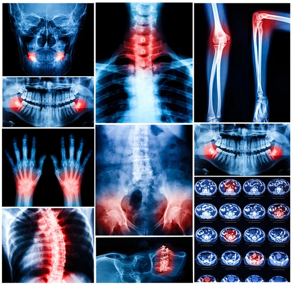 Collage of human X-rays photo — Stock Photo, Image