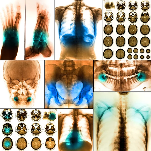 인간 x-레이 사진 콜라주 — 스톡 사진