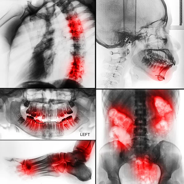 İnsan röntgen fotoğrafları — Stok fotoğraf