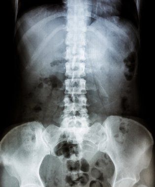 İnsan kemikleri X-Ray tarama