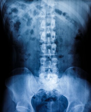 İnsan kemikleri X-Ray tarama