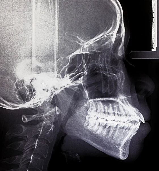 X-Ray scan of teeth — Stock Photo, Image