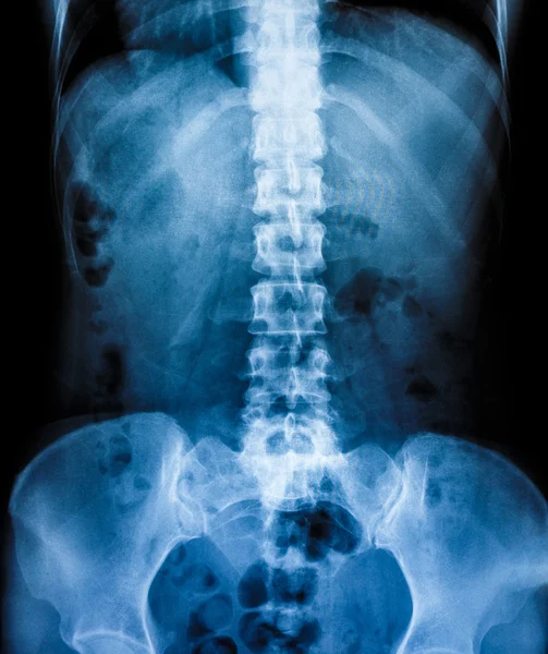 人間の骨の x 線スキャン — ストック写真