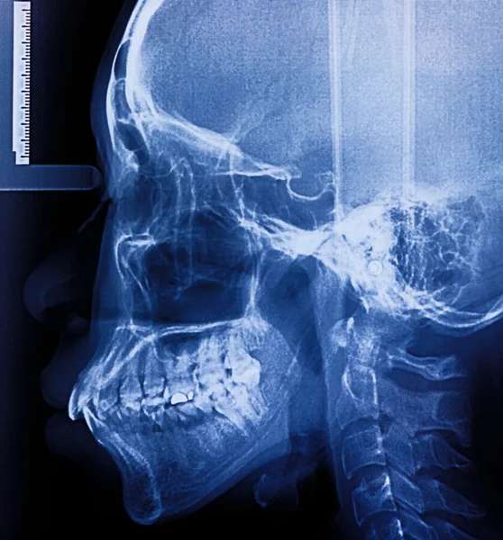 X-Ray scan of teeth — Stock Photo, Image