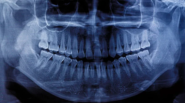 X-ray skanowania zębów — Zdjęcie stockowe