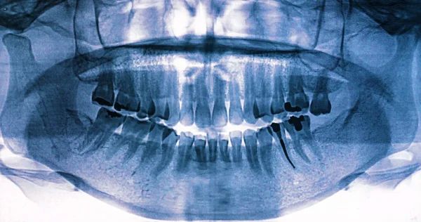 X-ray skanowania człowieka — Zdjęcie stockowe