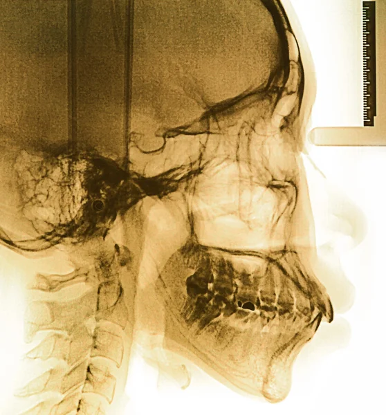 Рентгеновское сканирование человека — стоковое фото