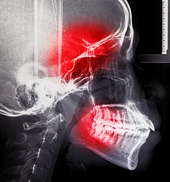 X-ray skanowania ludzkiego do zębów — Zdjęcie stockowe