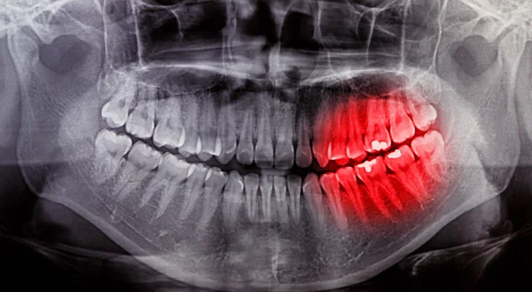 X-ray tarama dişler için insan — Stok fotoğraf