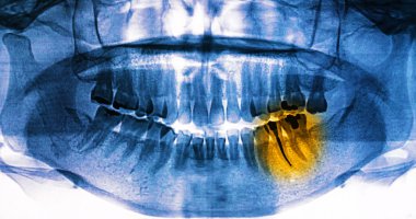 x-ray tarama dişler için insan 