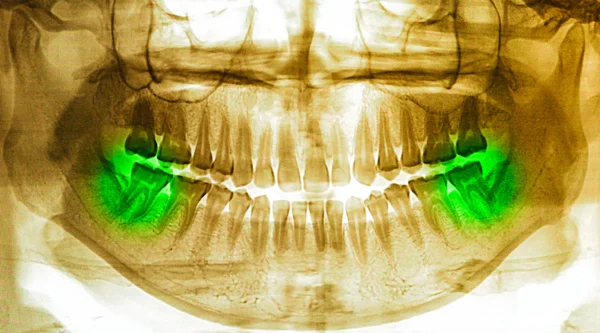 X-ray tarama dişler için insan — Stok fotoğraf