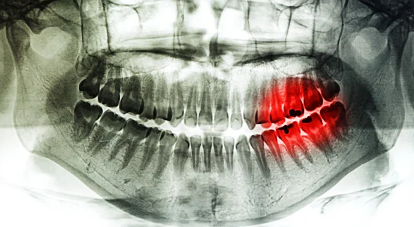 X-ray scan menselijke voor tanden — Stockfoto