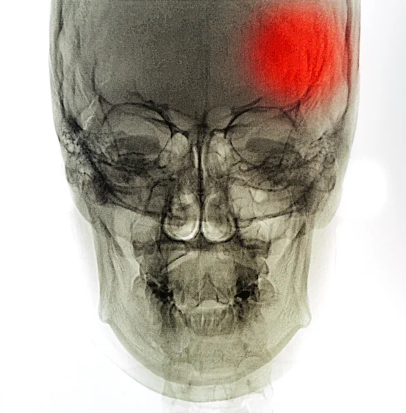 X-ray skanowania człowieka — Zdjęcie stockowe