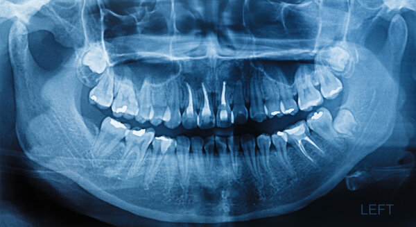 рентгеновское сканирование человека
