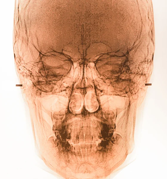 Плівка рентгенівського сканування людини — стокове фото