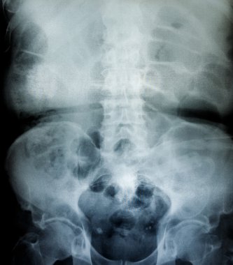 Film X-Ray tarama insan