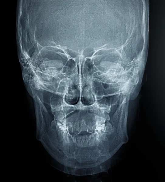 Film X-Ray scan of human — Stock Photo, Image