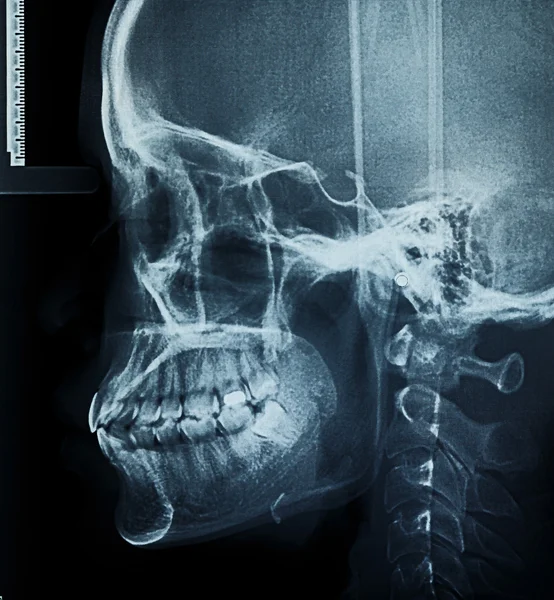 Film X-Ray scan of human — Stock Photo, Image