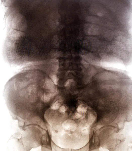 İnsan kemikleri X-Ray tarama — Stok fotoğraf