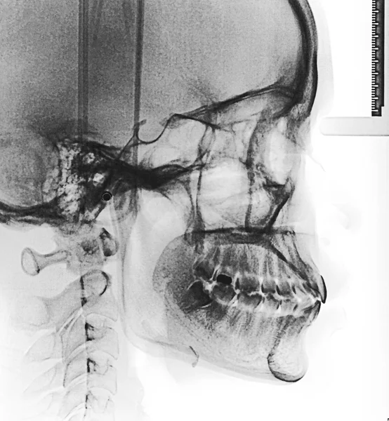 Skanowanie filmu X-Ray czaszki — Zdjęcie stockowe