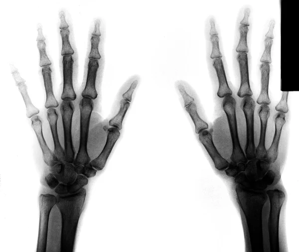 X-Ray scan of human hands — Stock Photo, Image