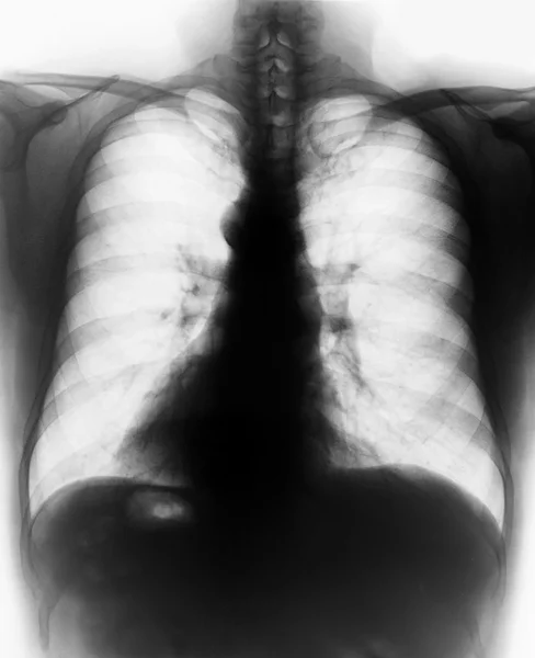 Radiographie des poumons humains — Photo