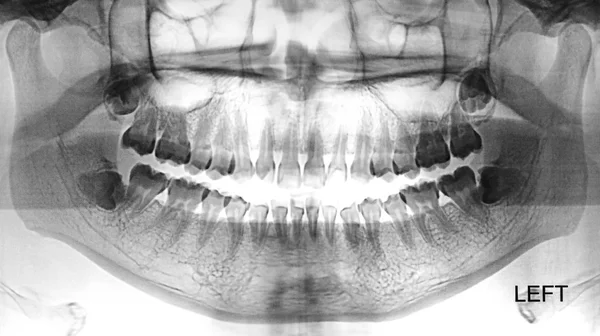 Film X-Ray scan of teeth — Stock Photo, Image