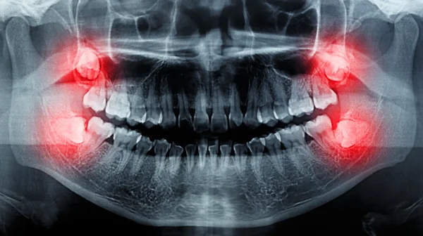 Film X-Ray tarama insan