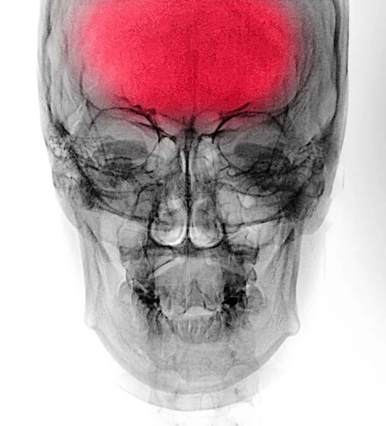 Рентгенівський знімок кісток людини — стокове фото