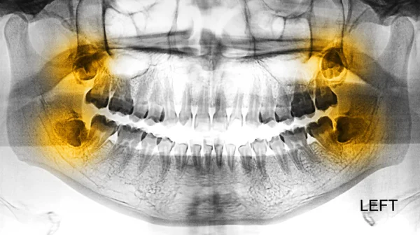 Film X-Ray scan of human bones — Stock Photo, Image