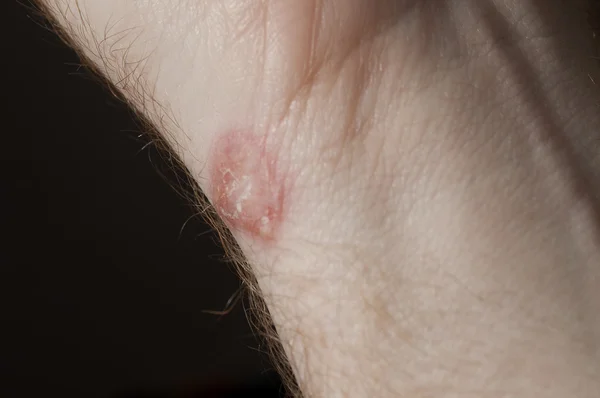 Ringworm on white man / Mycosis — Stock Photo, Image