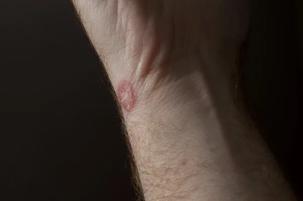 Ringworm on white man / Mycosis — Stock Photo, Image