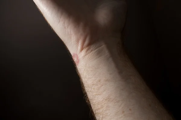 Ringworm on white man / Mycosis — Stock Photo, Image