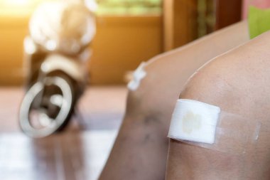 Kandaki kumaş yarasının kapanması yansıma ve motosiklet kazası lezyonunun yan etkisi.