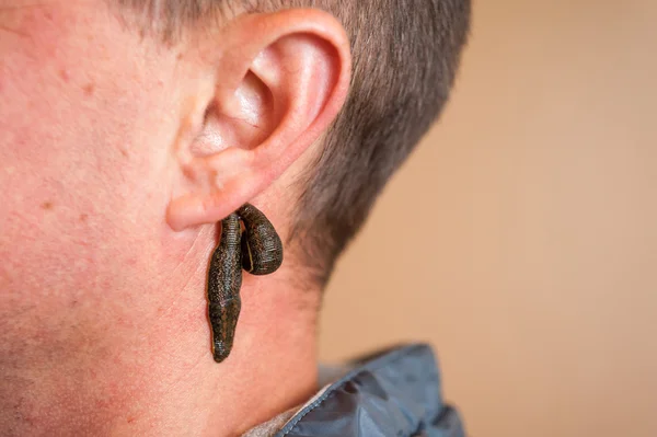 Leech therapy for a man — Stock Photo, Image