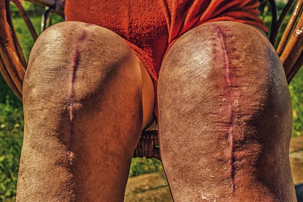 scars of old person legs who underwent knee replacement operations