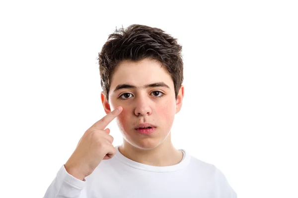 Akne kaukasischer Junge zeigt mit rechtem Zeigefinger auf sein Auge — Stockfoto