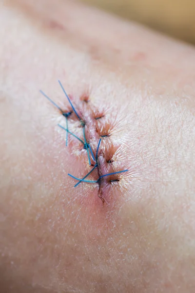 Stitched wound — Stock Photo, Image