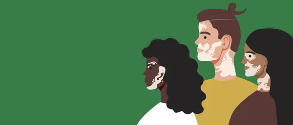 Vitiligo hastaları depigmentasyonu olan, uzay şablonunu kopyalayan. Düz vektör stok çizimi. Cildinde vitiligo lekeleri olan insanlar, tasarımın şablonu olarak milanin problemi. Örtülü resimleme