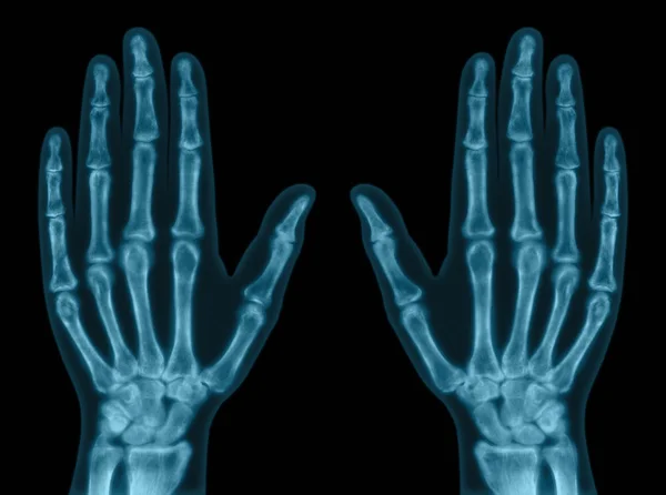 X-ray of both hands — Stock Photo, Image