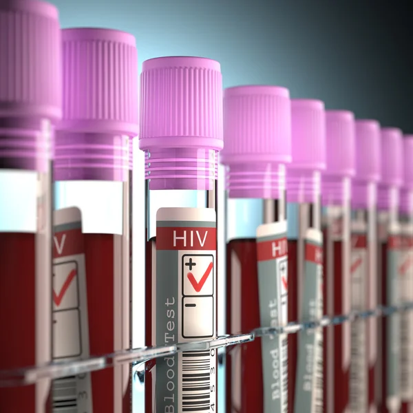 Risultato del test HIV — Foto Stock