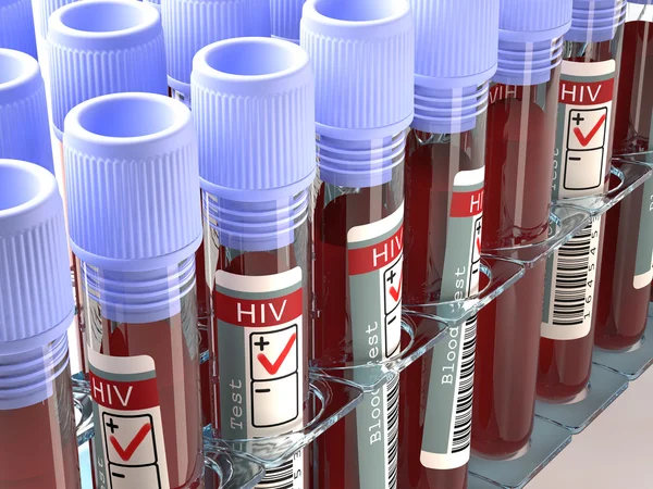 Hiv 테스트의 결과 — 스톡 사진