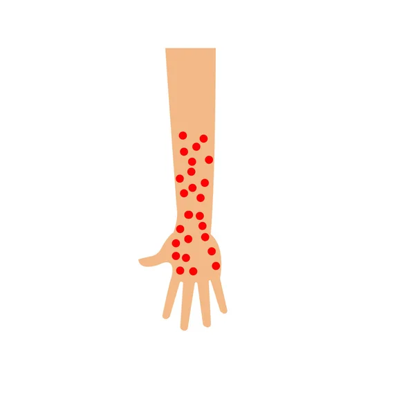 Chickenpox Disease Hand Illustration — Stock Photo, Image